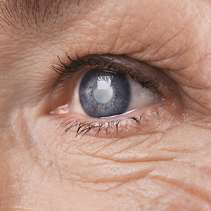 The image shows a close-up view of an elderly person s eye with a visible blue iris and a white pupil, reflecting light, set within a wrinkled skin area around the eyelid.